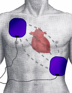 Namestitev elektrod AED